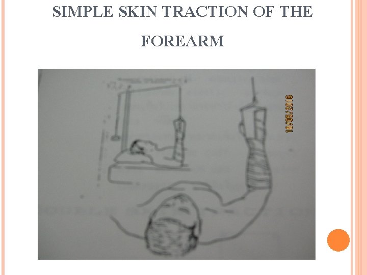 SIMPLE SKIN TRACTION OF THE FOREARM 