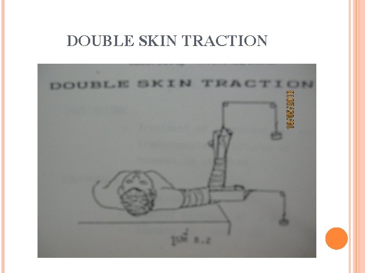 DOUBLE SKIN TRACTION 