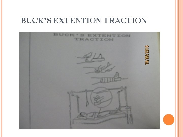 BUCK’S EXTENTION TRACTION 