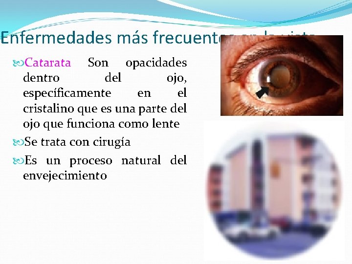 Enfermedades más frecuentes en la vista Catarata Son opacidades dentro del ojo, específicamente en