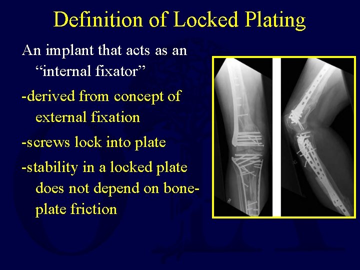 Definition of Locked Plating An implant that acts as an “internal fixator” -derived from