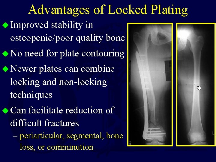 Advantages of Locked Plating u Improved stability in osteopenic/poor quality bone u No need