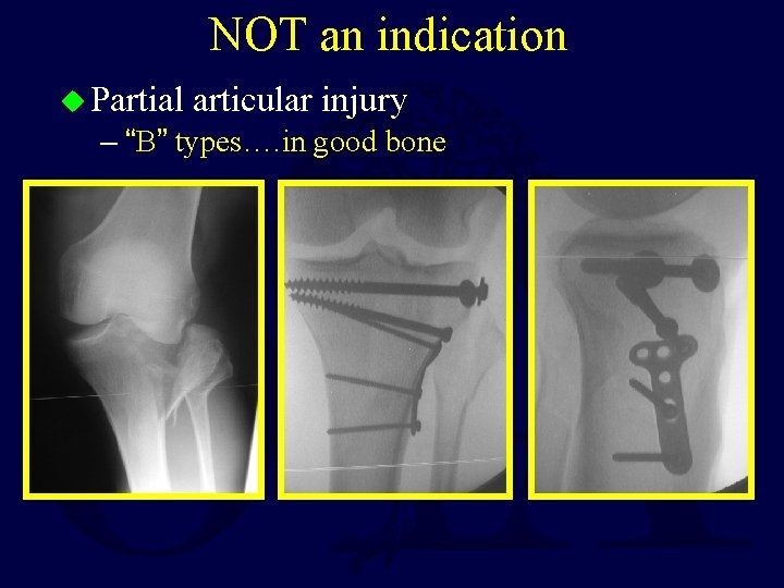 NOT an indication u Partial articular injury – “B” types…. in good bone 