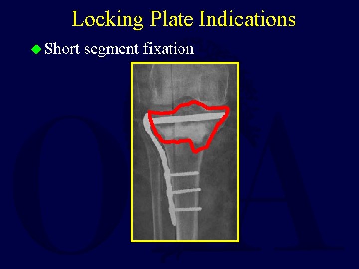 Locking Plate Indications u Short segment fixation 