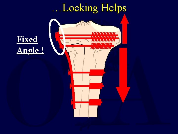 …Locking Helps Fixed Angle ! 