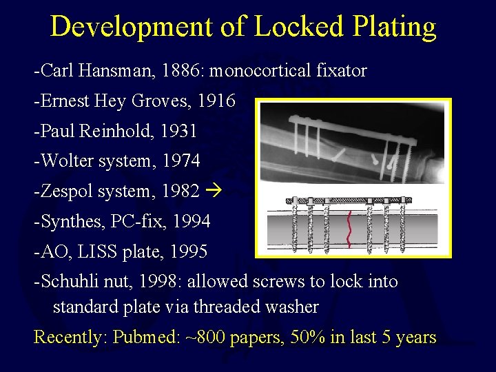 Development of Locked Plating -Carl Hansman, 1886: monocortical fixator -Ernest Hey Groves, 1916 -Paul