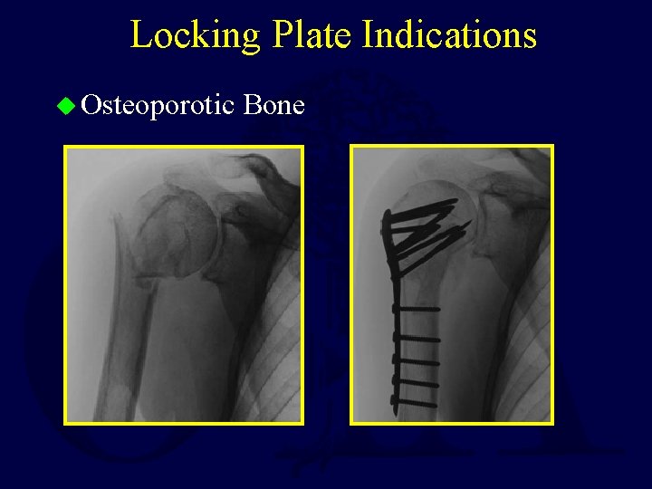 Locking Plate Indications u Osteoporotic Bone 