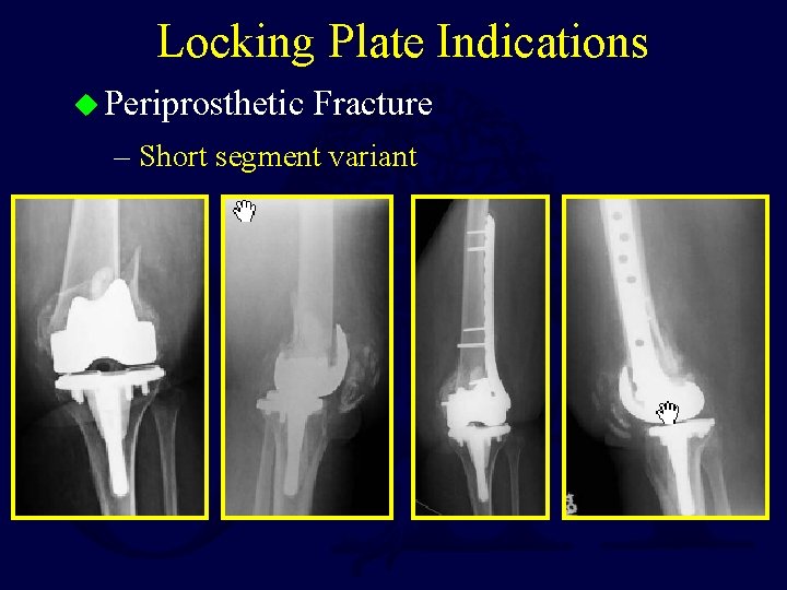 Locking Plate Indications u Periprosthetic Fracture – Short segment variant 