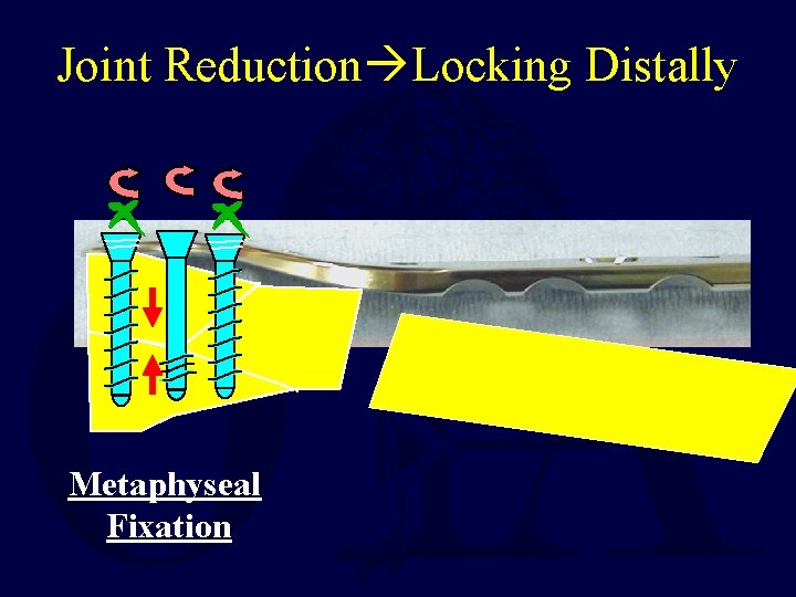 Joint Reduction Locking Distally Metaphyseal Fixation 