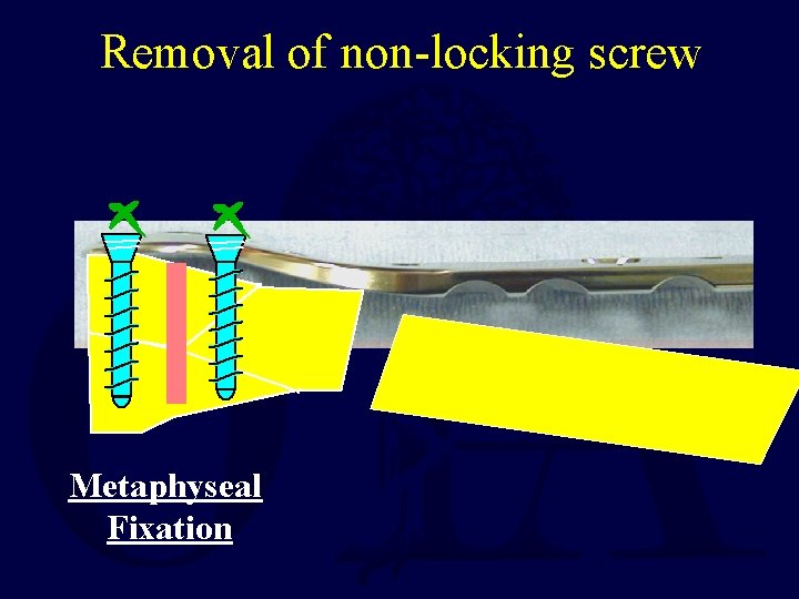 Removal of non-locking screw Metaphyseal Fixation 