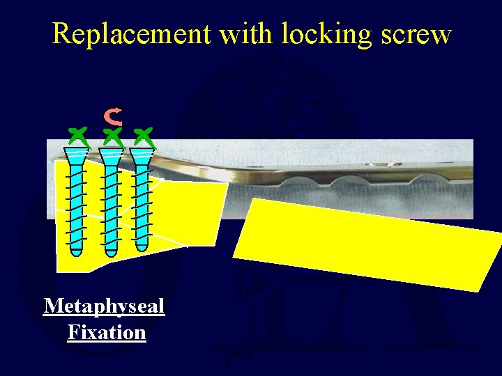 Replacement with locking screw Metaphyseal Fixation 