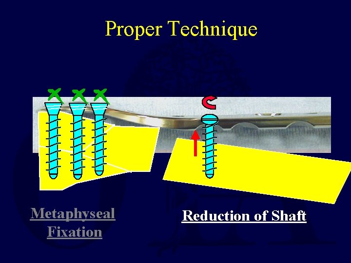 Proper Technique Metaphyseal Fixation Reduction of Shaft 