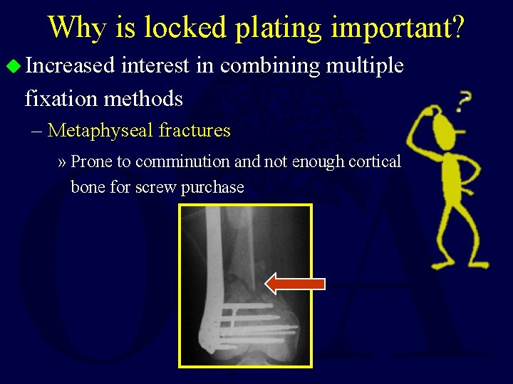 Why is locked plating important? u Increased interest in combining multiple fixation methods –