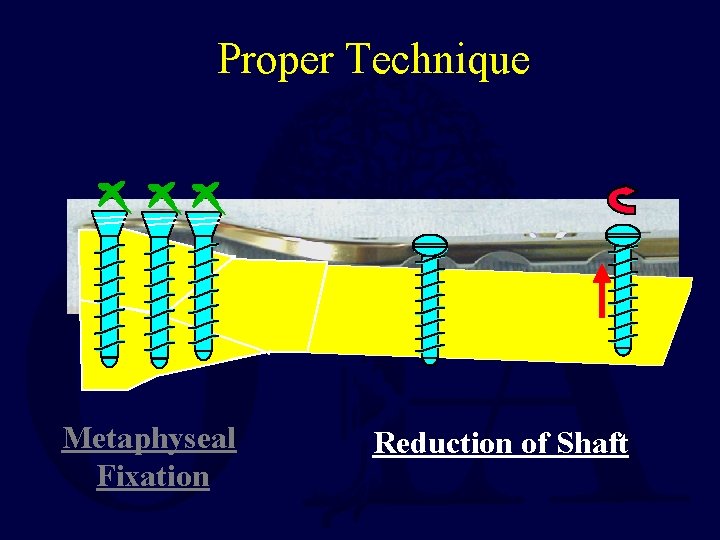Proper Technique Metaphyseal Fixation Reduction of Shaft 
