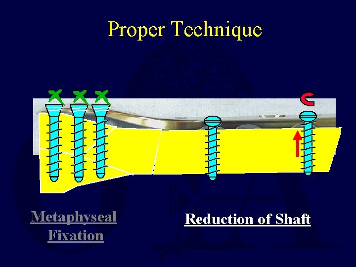 Proper Technique Metaphyseal Fixation Reduction of Shaft 