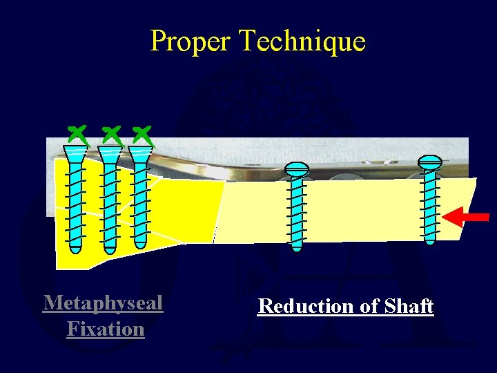 Proper Technique Metaphyseal Fixation Reduction of Shaft 