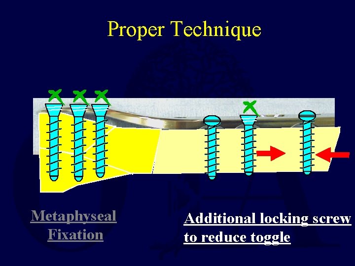Proper Technique Metaphyseal Fixation Additional locking screw to reduce toggle 