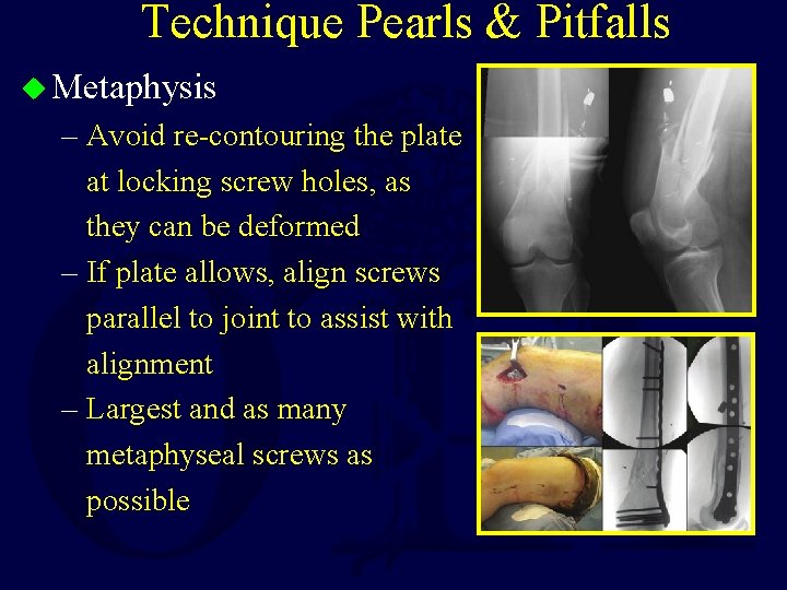 Technique Pearls & Pitfalls u Metaphysis – Avoid re-contouring the plate at locking screw