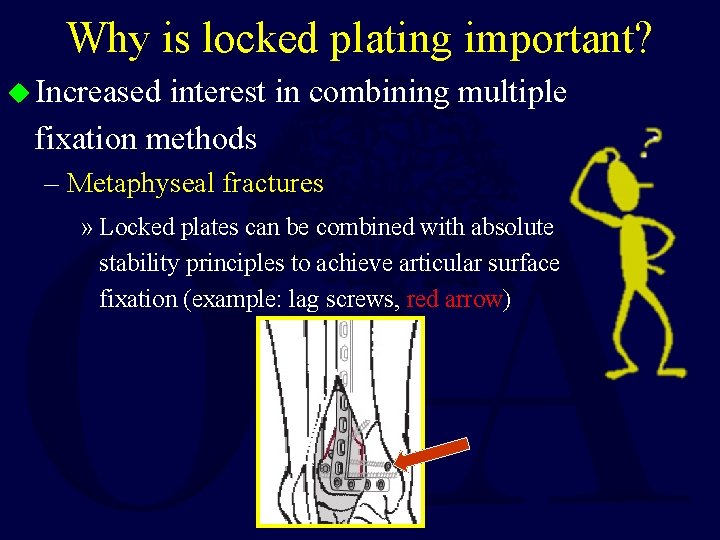 Why is locked plating important? u Increased interest in combining multiple fixation methods –