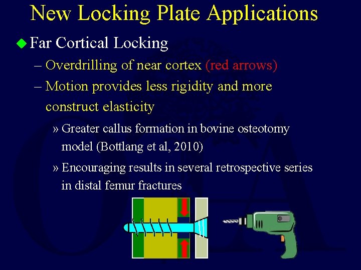 New Locking Plate Applications u Far Cortical Locking – Overdrilling of near cortex (red