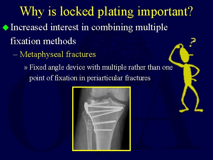 Why is locked plating important? u Increased interest in combining multiple fixation methods –