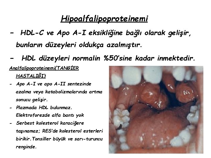 Hipoalfalipoproteinemi - HDL-C ve Apo A-I eksikliğine bağlı olarak gelişir, bunların düzeyleri oldukça azalmıştır.