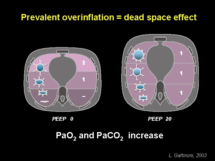 Prevalent overinflation = dead space effect 1 2 1 1 1 – PEEP 0