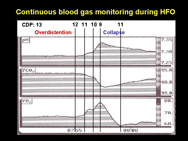 Continuous blood gas monitoring during HFO 12 11 10 9 11 CDP: 13 Overdistention