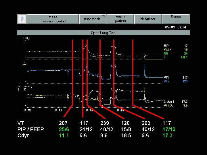 VT PIP / PEEP Cdyn 207 25/6 11. 1 117 24/12 9. 6 239