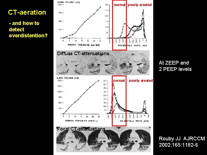 normal poorly areated CT-aeration - and how to detect overdistention? Diffuse CT-attenuations At ZEEP