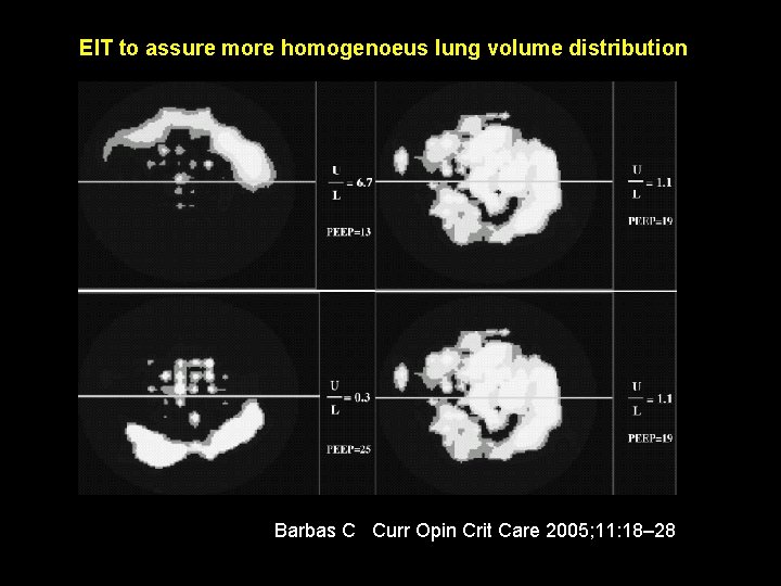 EIT to assure more homogenoeus lung volume distribution Barbas C Curr Opin Crit Care