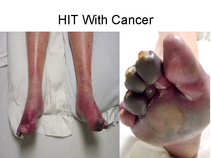 HIT With Cancer 