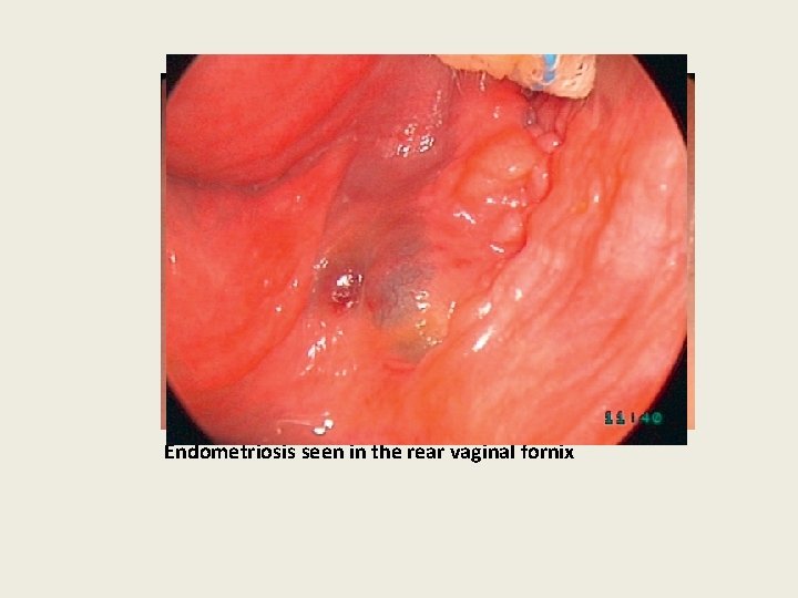 Endometriosis seen in the rear vaginal fornix 