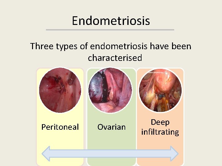 Endometriosis Three types of endometriosis have been characterised Peritoneal Ovarian Deep infiltrating 
