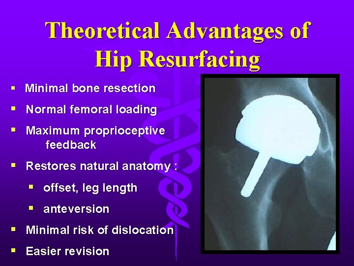 Theoretical Advantages of Hip Resurfacing § Minimal bone resection § Normal femoral loading §