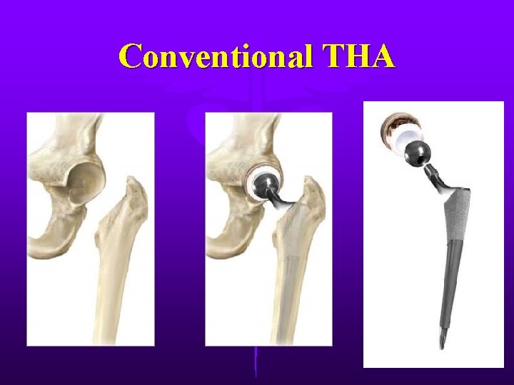 Conventional THA 