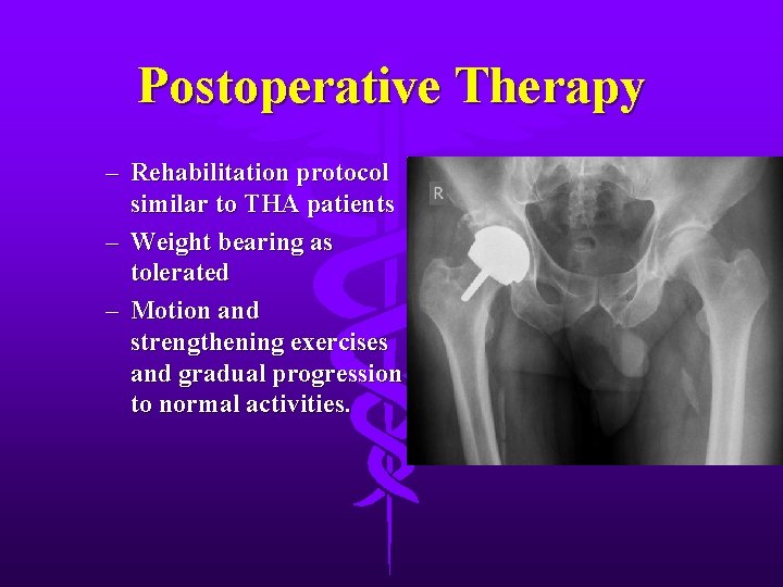Postoperative Therapy – Rehabilitation protocol similar to THA patients – Weight bearing as tolerated