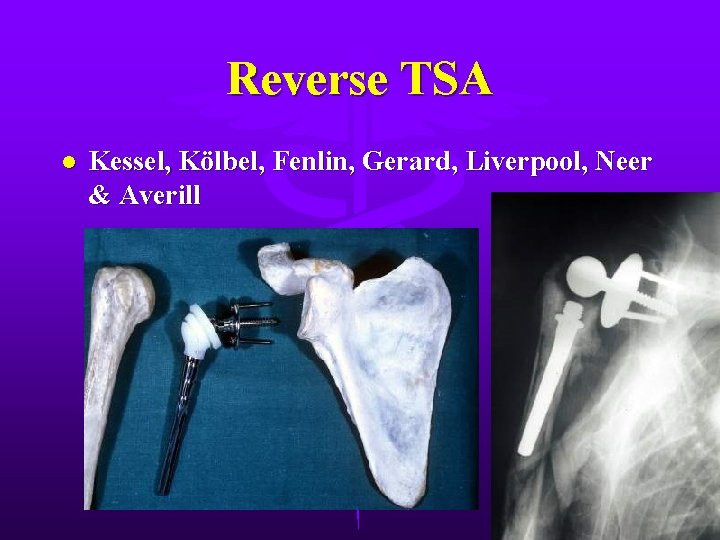 Reverse TSA l Kessel, Kölbel, Fenlin, Gerard, Liverpool, Neer & Averill 