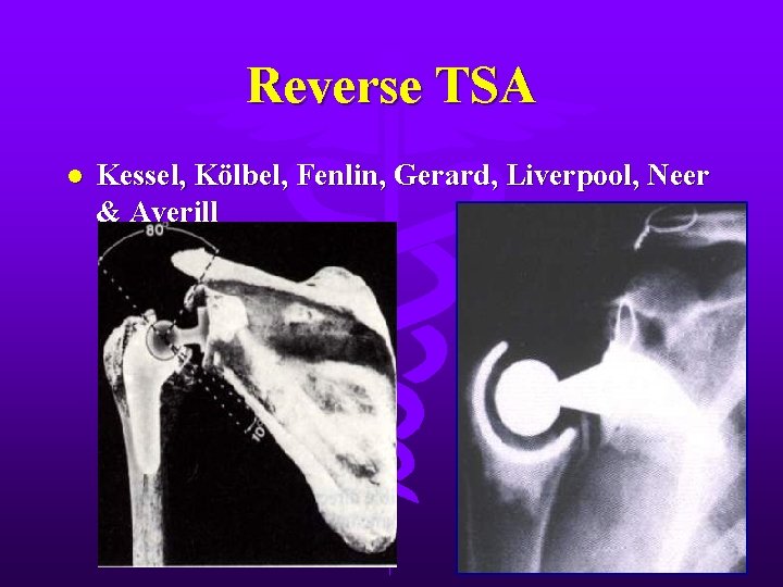Reverse TSA l Kessel, Kölbel, Fenlin, Gerard, Liverpool, Neer & Averill 