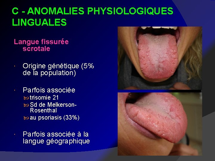 C - ANOMALIES PHYSIOLOGIQUES LINGUALES Langue fissurée scrotale Origine génétique (5% de la population)