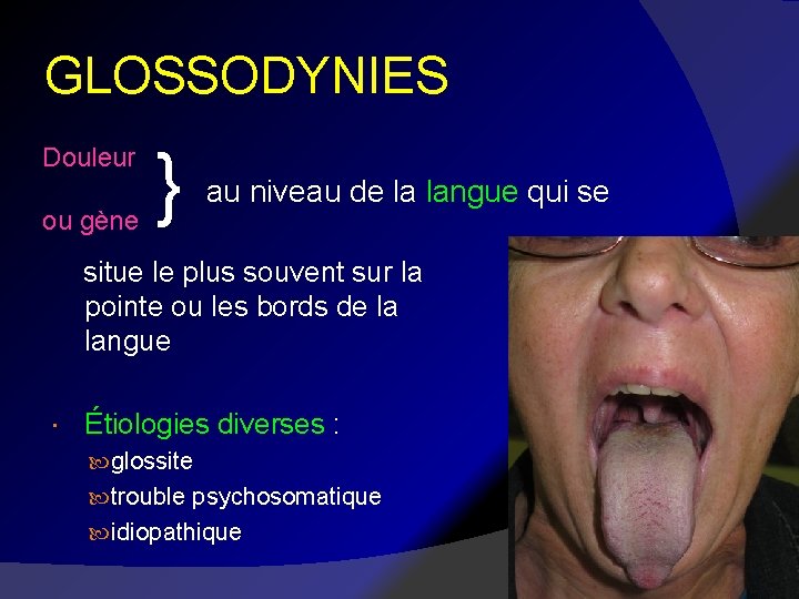 GLOSSODYNIES Douleur ou gène } au niveau de la langue qui se situe le