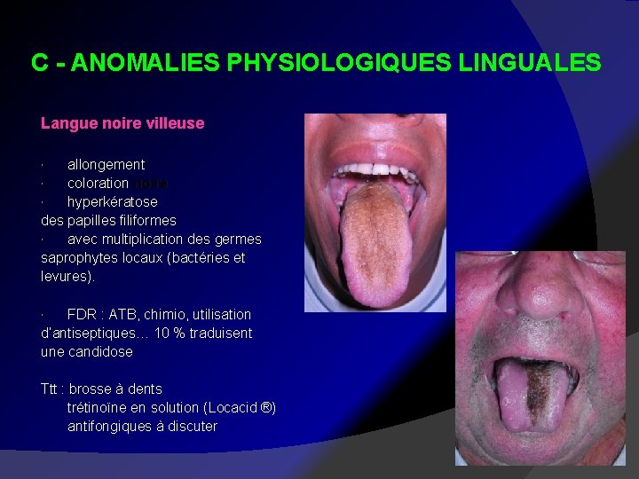 C - ANOMALIES PHYSIOLOGIQUES LINGUALES Langue noire villeuse allongement coloration noire hyperkératose des papilles
