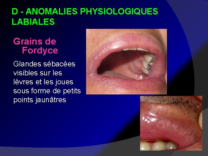 D - ANOMALIES PHYSIOLOGIQUES LABIALES Grains de Fordyce Glandes sébacées visibles sur les lèvres