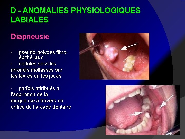 D - ANOMALIES PHYSIOLOGIQUES LABIALES Diapneusie pseudo-polypes fibroépithéliaux nodules sessiles arrondis mollasses sur les