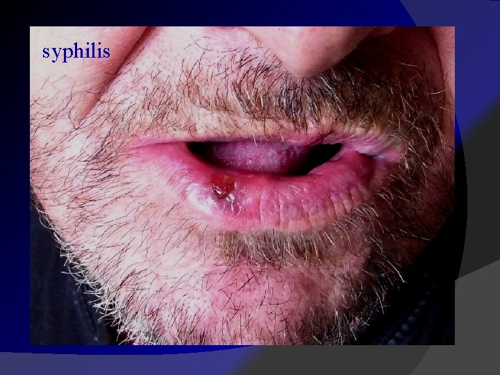 syphilis 