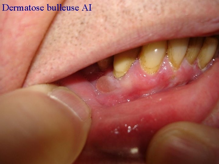 Dermatose bulleuse AI 