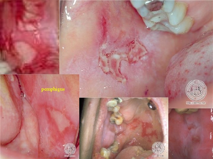 pemphigus 