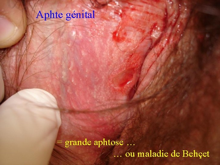 Aphte génital = grande aphtose … … ou maladie de Behçet 