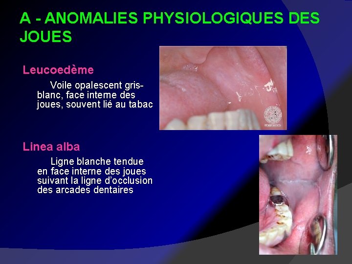 A - ANOMALIES PHYSIOLOGIQUES DES JOUES Leucoedème Voile opalescent gris- blanc, face interne des