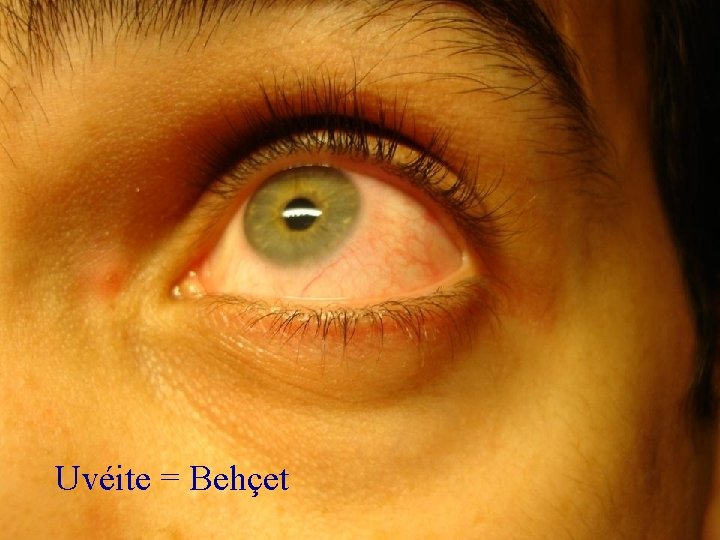 Uvéite = Behçet 
